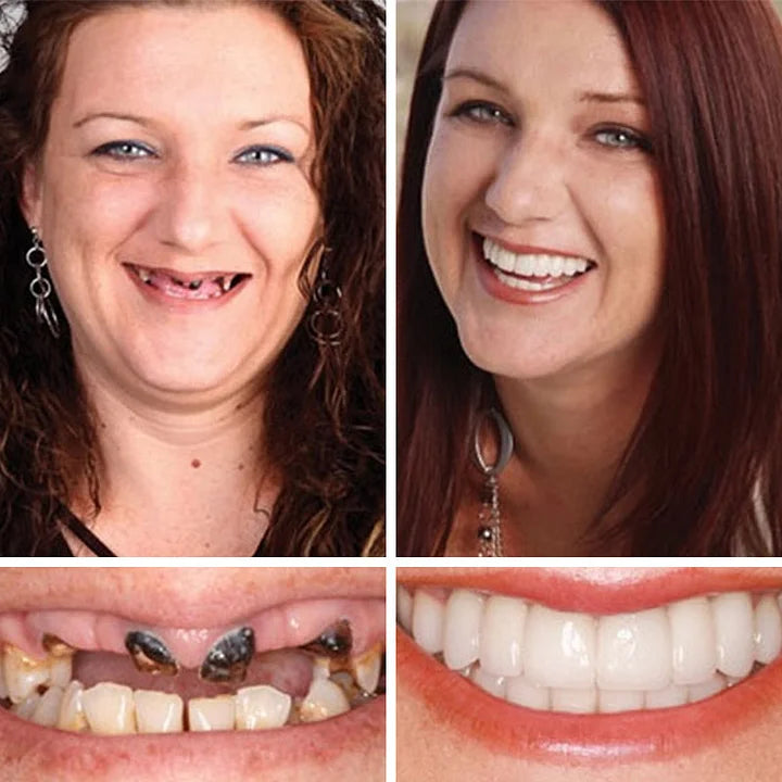 🌈Ends Today: 70% OFF! ⏰HazyGalaxy™  Medical Full Denture with Strong Suctiond Custom-Fit Full Functional Dentures🦷