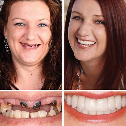 🌈Ends Today: 70% OFF! ⏰HazyGalaxy™  Medical Full Denture with Strong Suctiond Custom-Fit Full Functional Dentures🦷