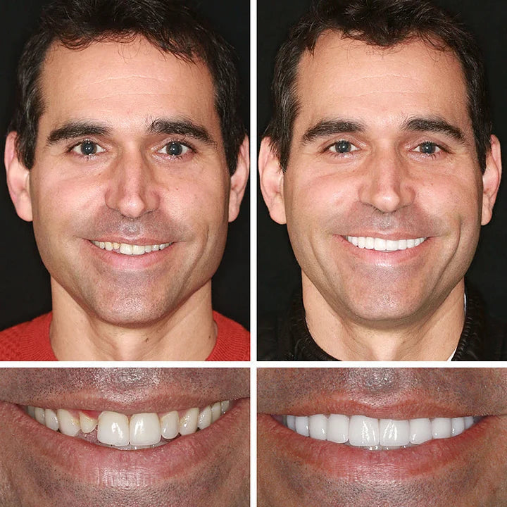 🏆Ends Today: 75% OFF! ⏰DarkFairy™ Medical Full Denture with Strong Suctiond Custom-Fit Full Functional Dentures🦷
