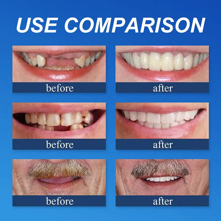 🌈Ends Today: 70% OFF! ⏰HazyGalaxy™  Medical Full Denture with Strong Suctiond Custom-Fit Full Functional Dentures🦷