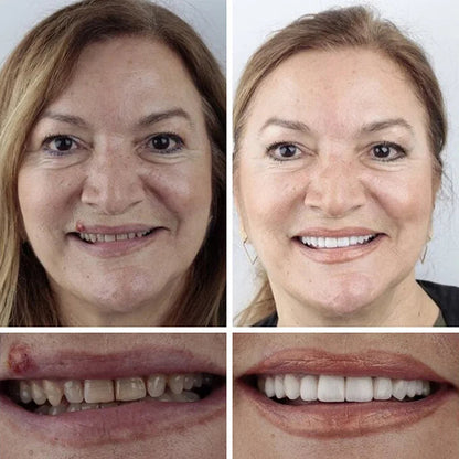 🌈Ends Today: 70% OFF! ⏰HazyGalaxy™  Medical Full Denture with Strong Suctiond Custom-Fit Full Functional Dentures🦷