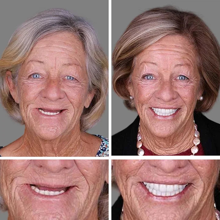 🌈Ends Today: 70% OFF! ⏰HazyGalaxy™  Medical Full Denture with Strong Suctiond Custom-Fit Full Functional Dentures🦷